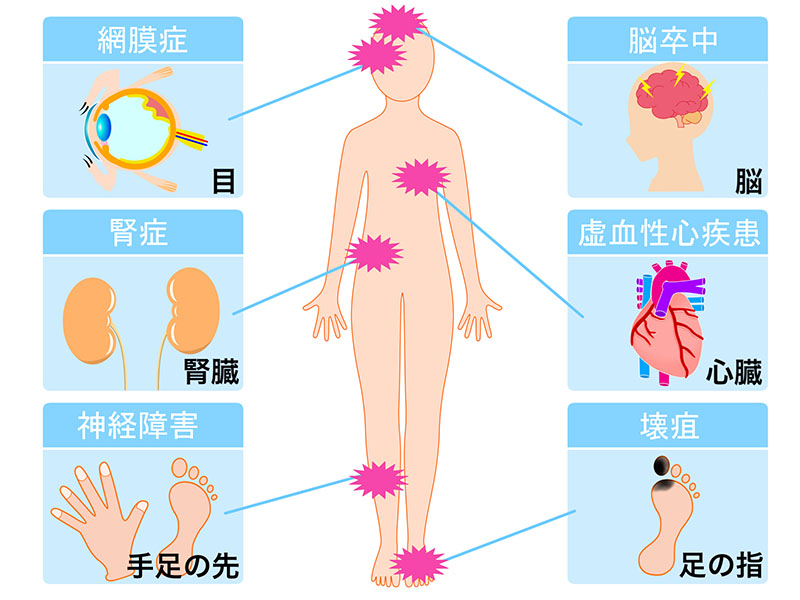 糖尿病