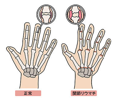 関節リウマチ
